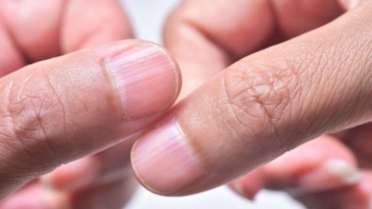 Nail And Hands Psoriasis