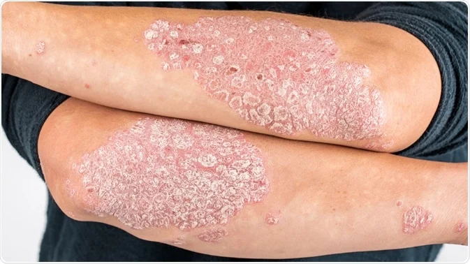 What is Psoriasis?