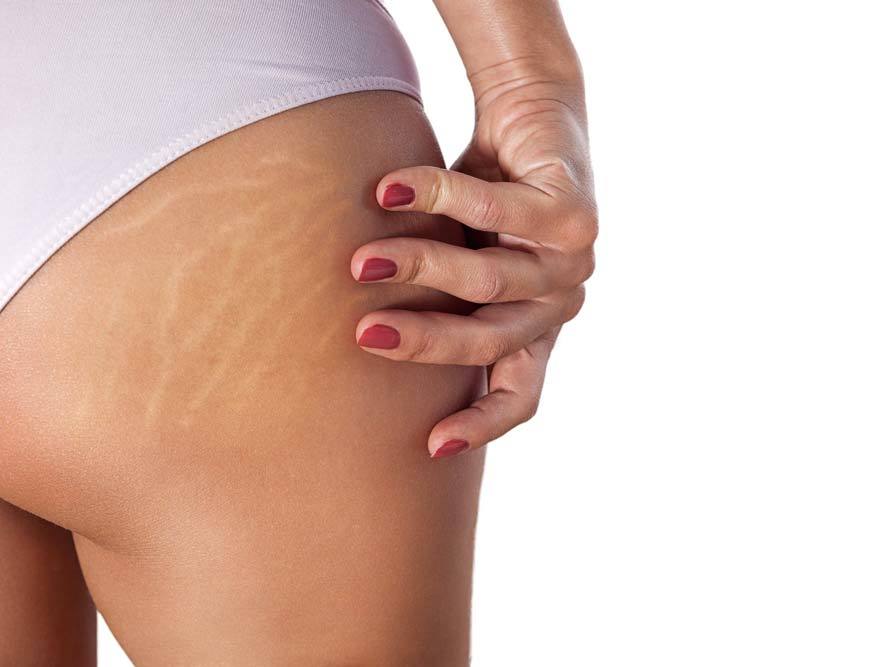 Sauna can help reduce cellulite and stretch marks.