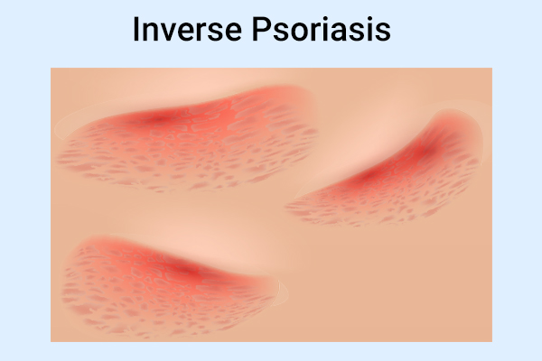 What are the Symptoms of Inverse Psoriasis?